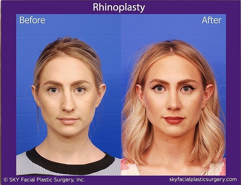 Rhinoplasty Before & After