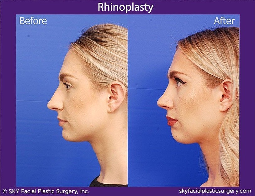 Rhinoplasty Before & After