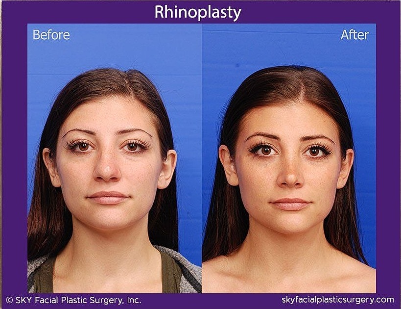 Rhinoplasty Before & After
