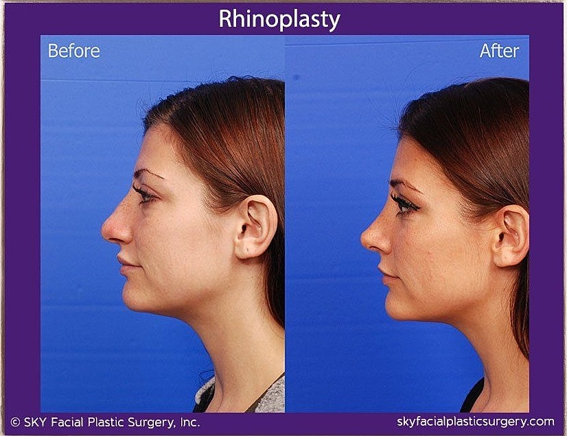 Rhinoplasty Before & After