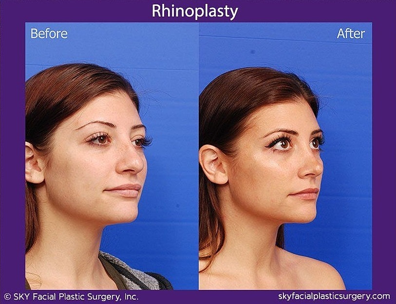 Rhinoplasty Before & After