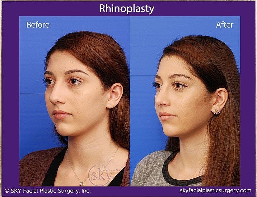 Rhinoplasty Before & After
