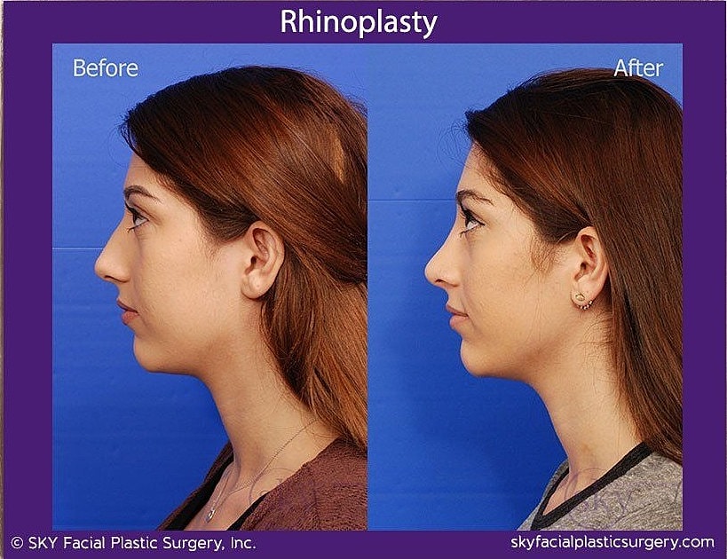 Rhinoplasty Before & After