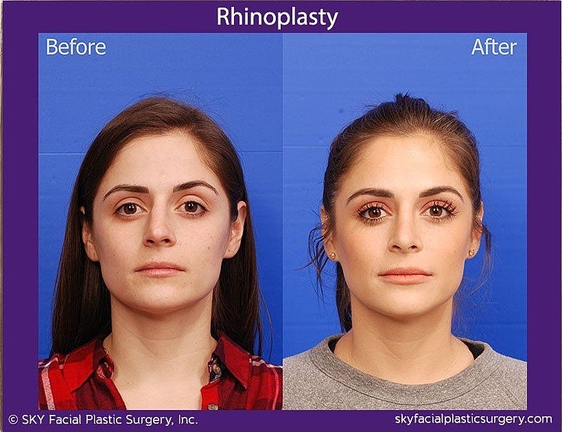 Rhinoplasty Before & After