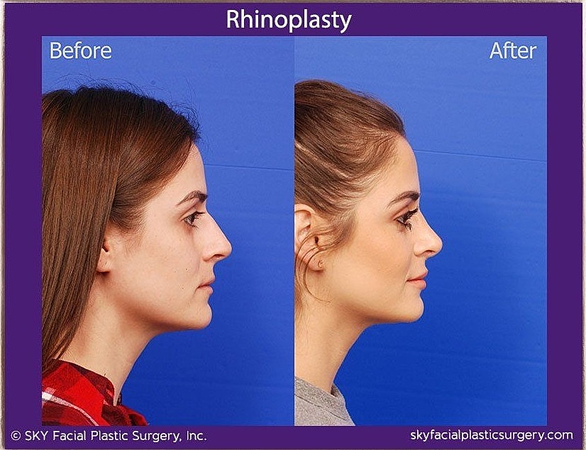 Rhinoplasty Before & After