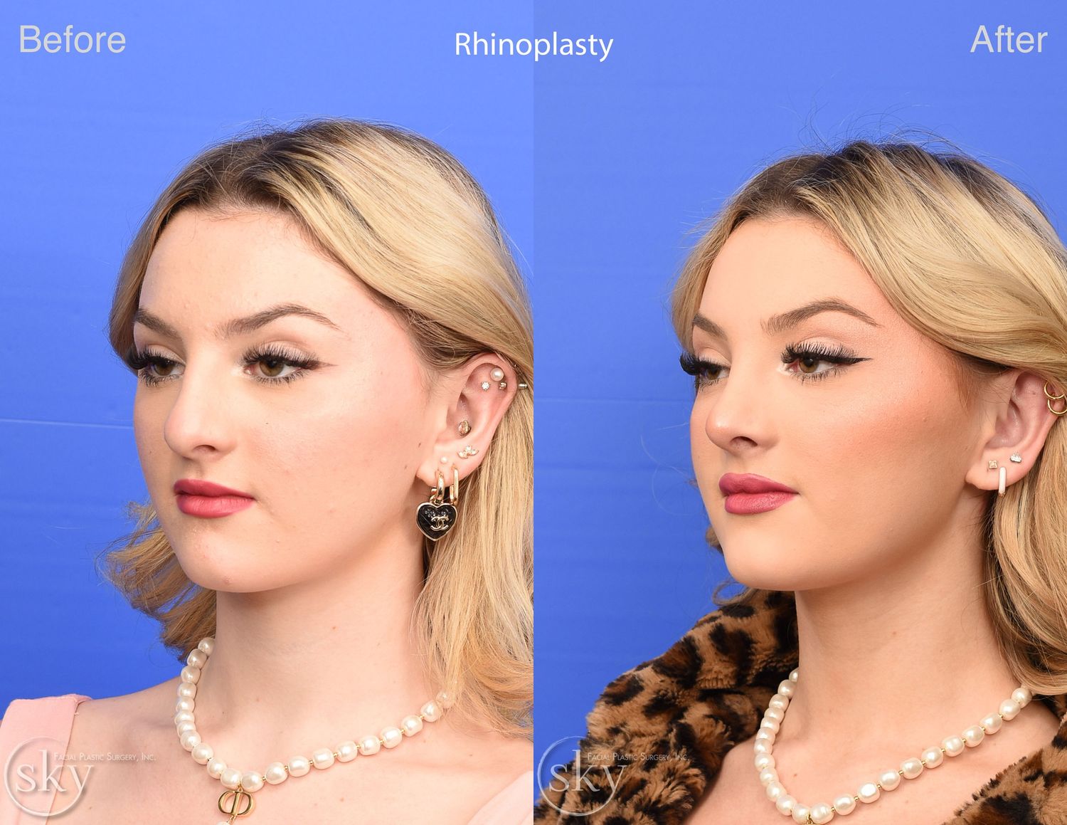 Rhinoplasty Before & After
