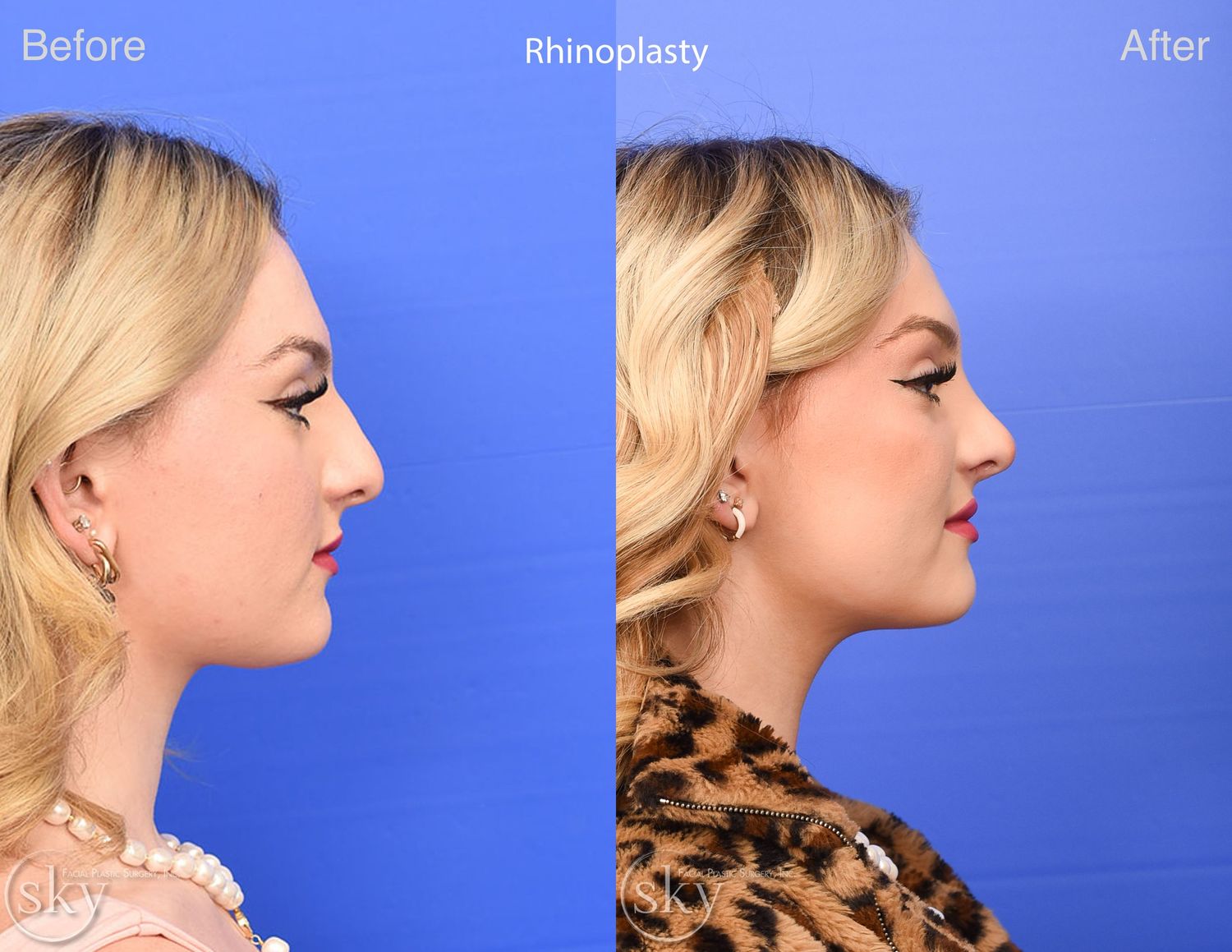 Rhinoplasty Before & After