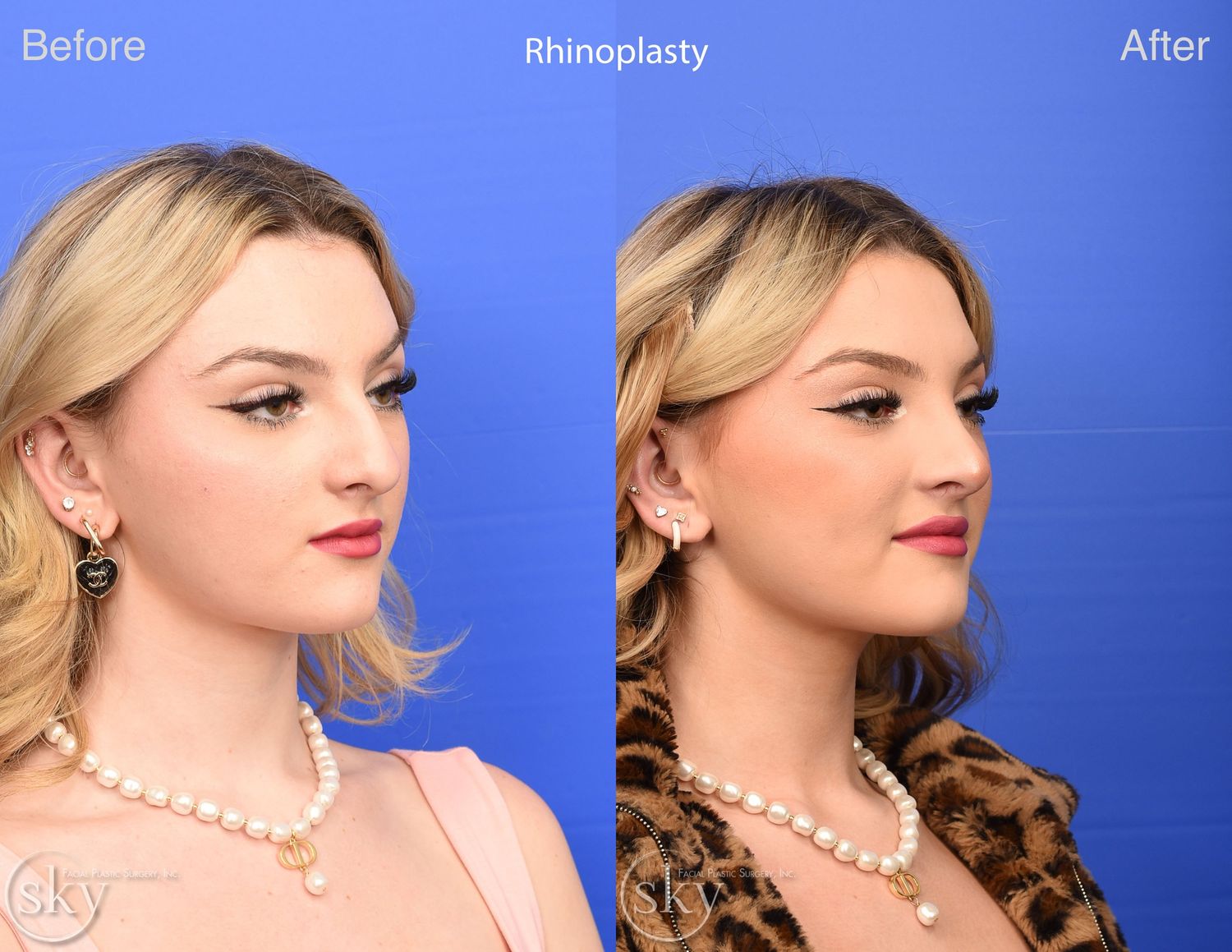 Rhinoplasty Before & After