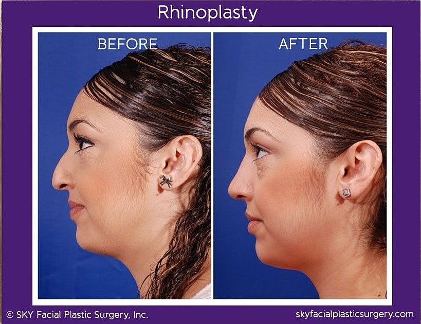 Rhinoplasty Before & After