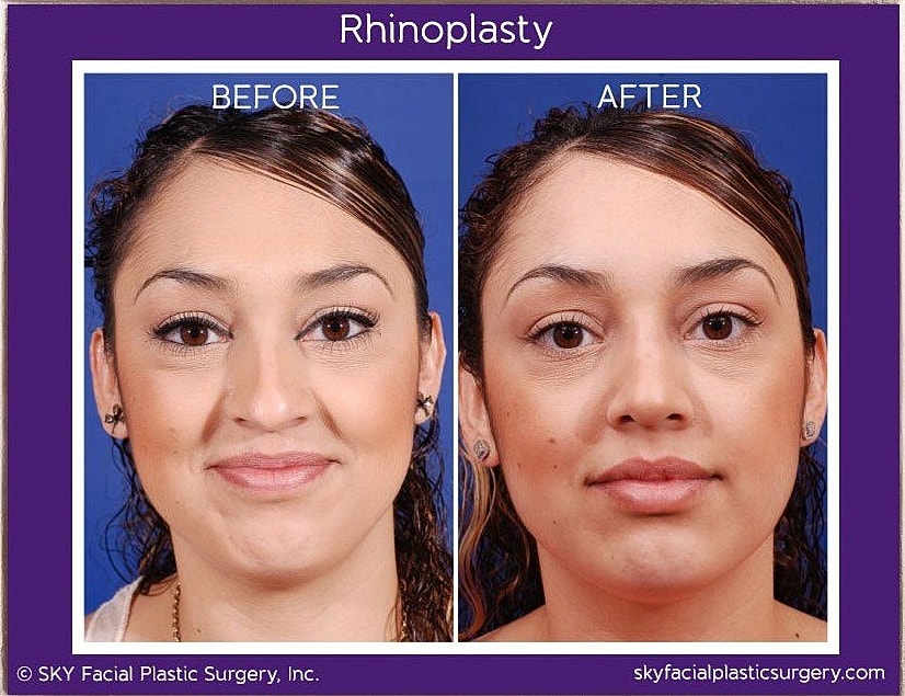 Rhinoplasty Before & After