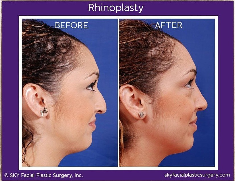 Rhinoplasty Before & After