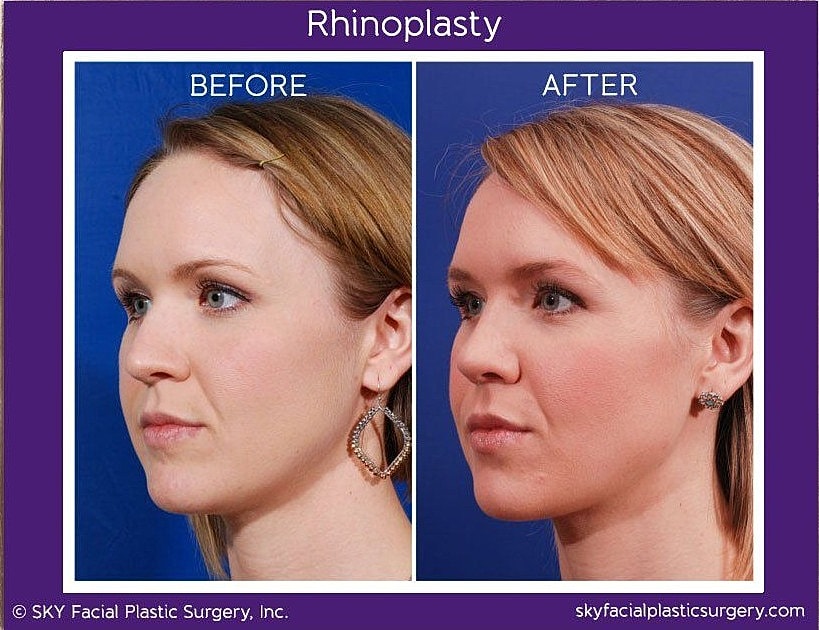 Rhinoplasty Before & After