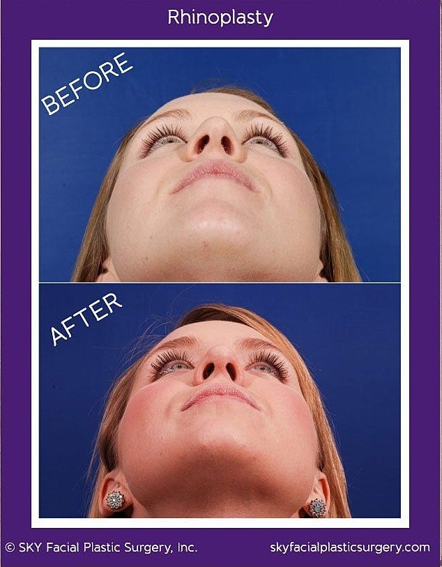 Rhinoplasty Before & After