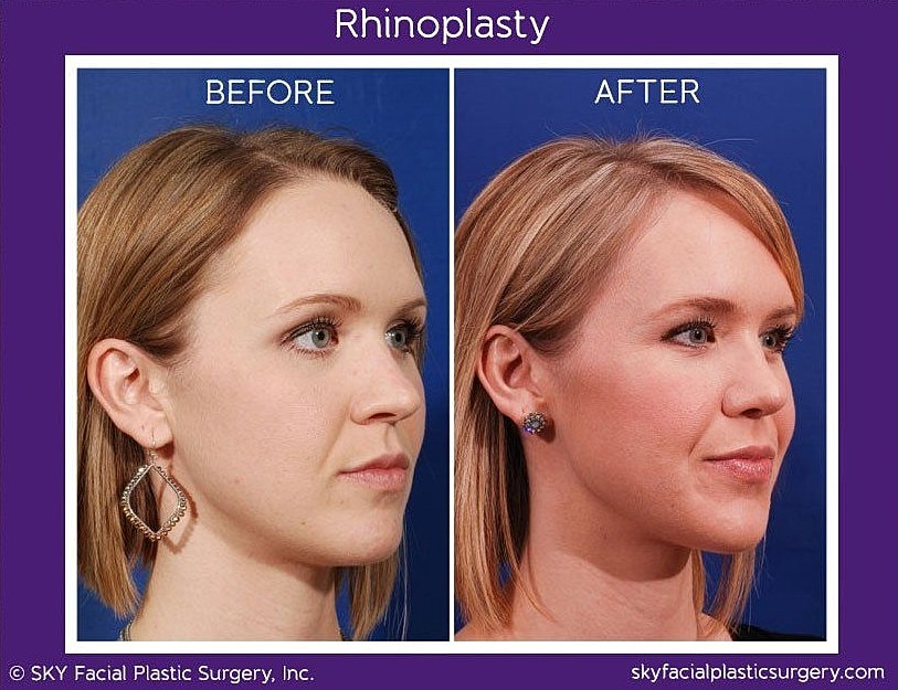 Rhinoplasty Before & After
