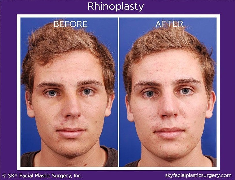 Rhinoplasty Before & After