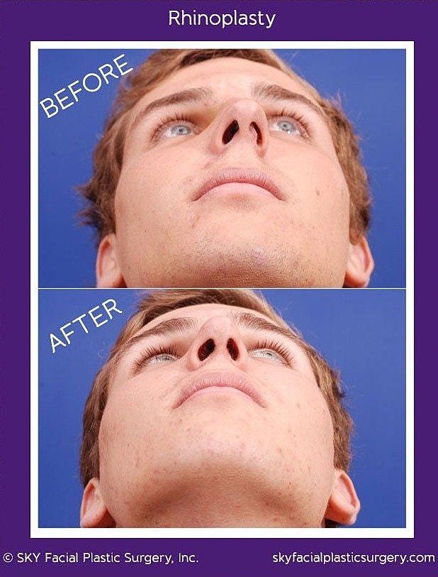 Rhinoplasty Before & After