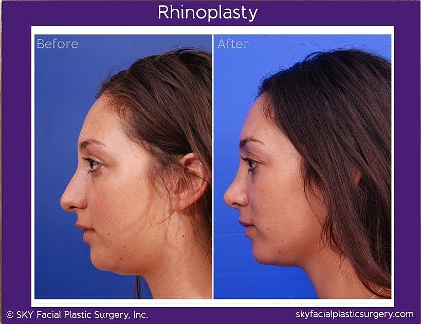Rhinoplasty Before & After