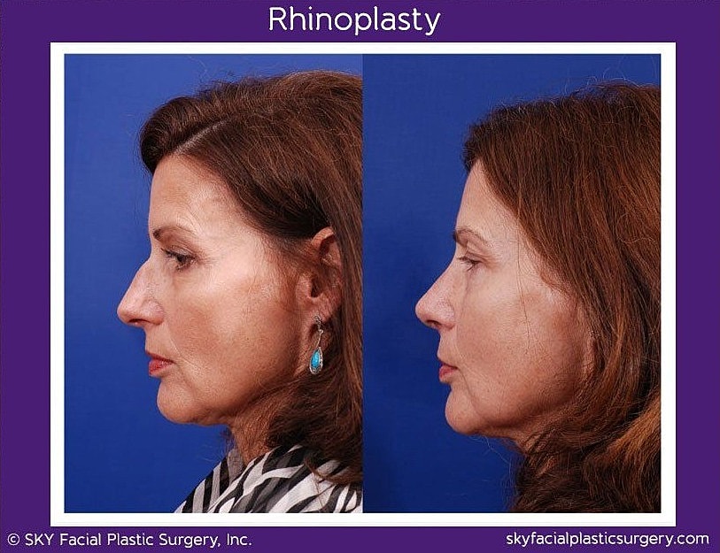 Rhinoplasty Before & After