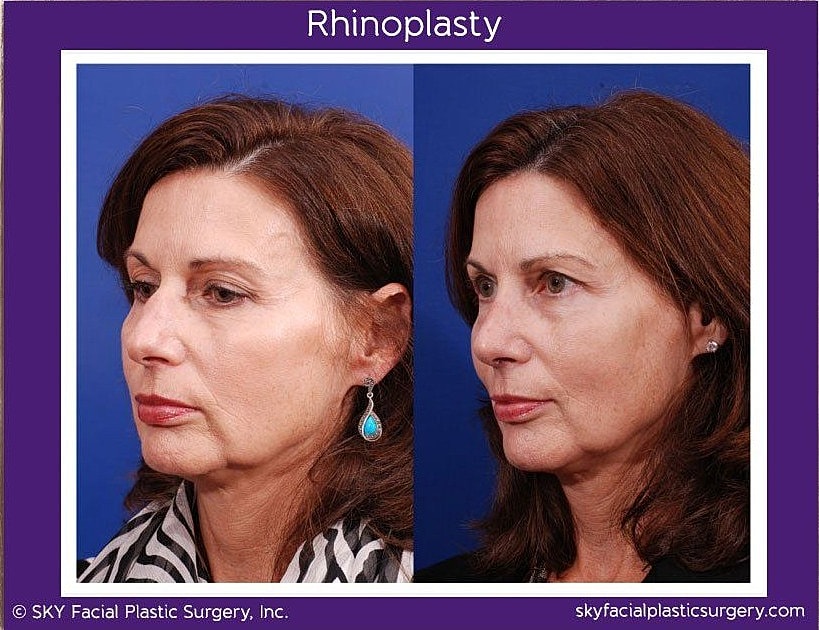 Rhinoplasty Before & After