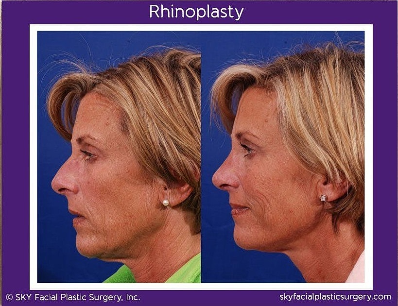 Rhinoplasty Before & After