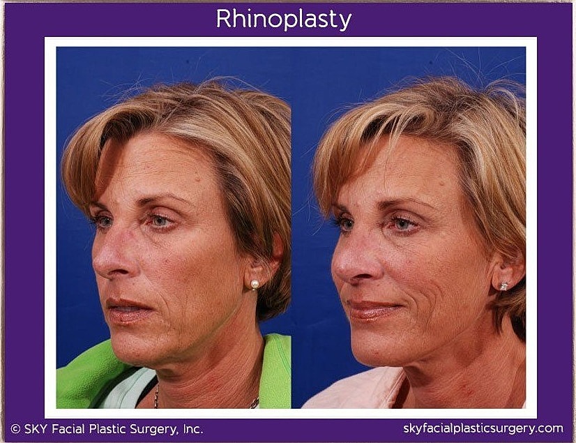 Rhinoplasty Before & After