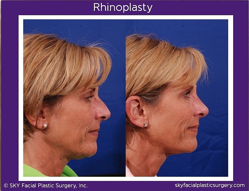 Rhinoplasty Before & After