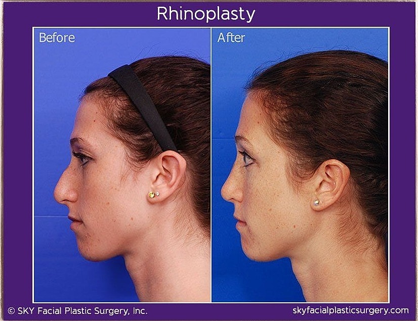 Rhinoplasty Before & After