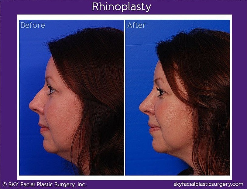 Rhinoplasty Before & After