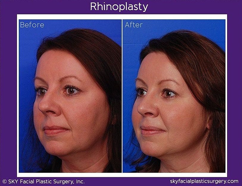 Rhinoplasty Before & After