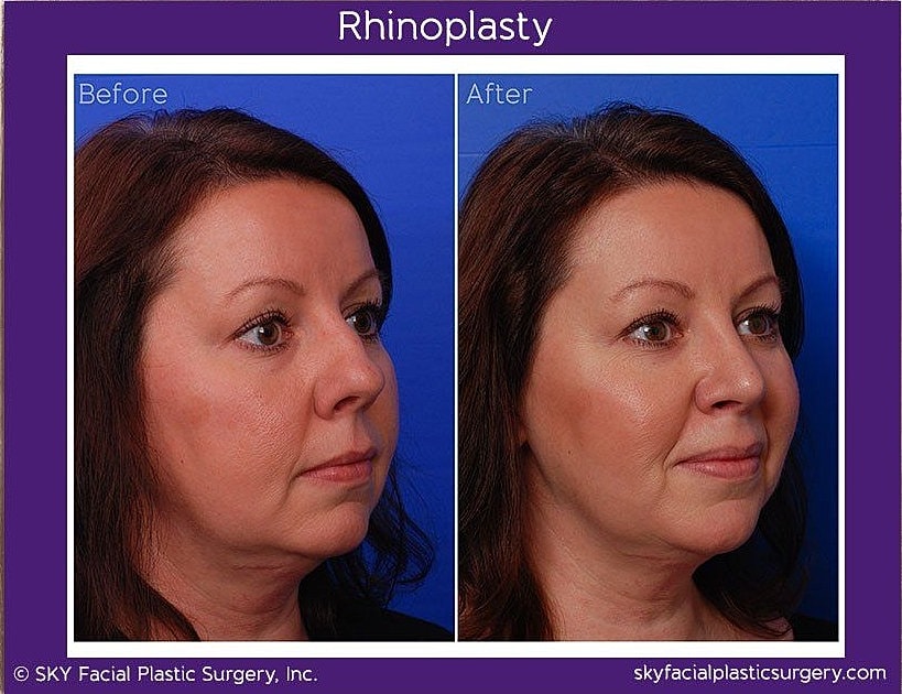 Rhinoplasty Before & After