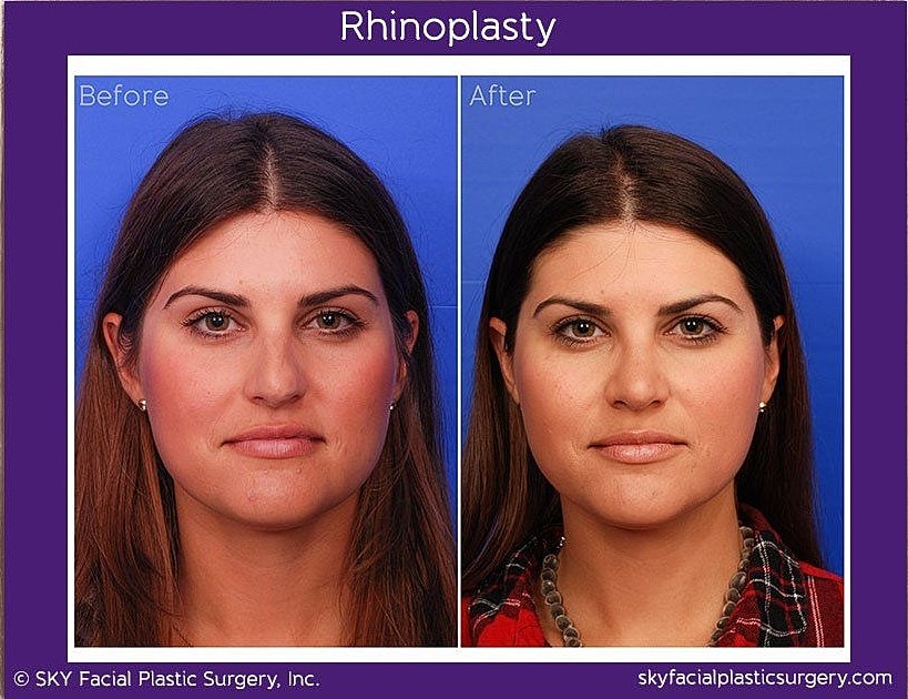 Rhinoplasty Before & After