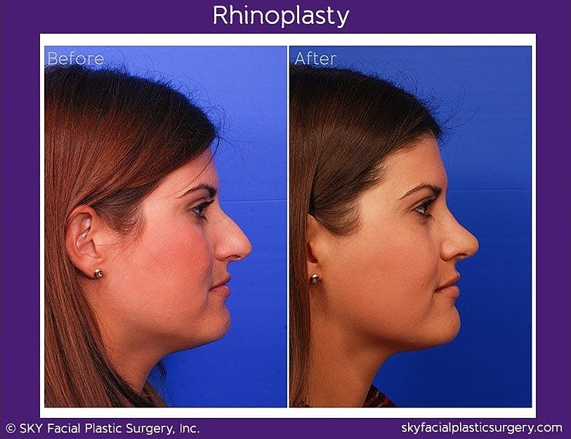 Rhinoplasty Before & After