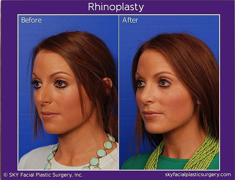 Rhinoplasty Before & After