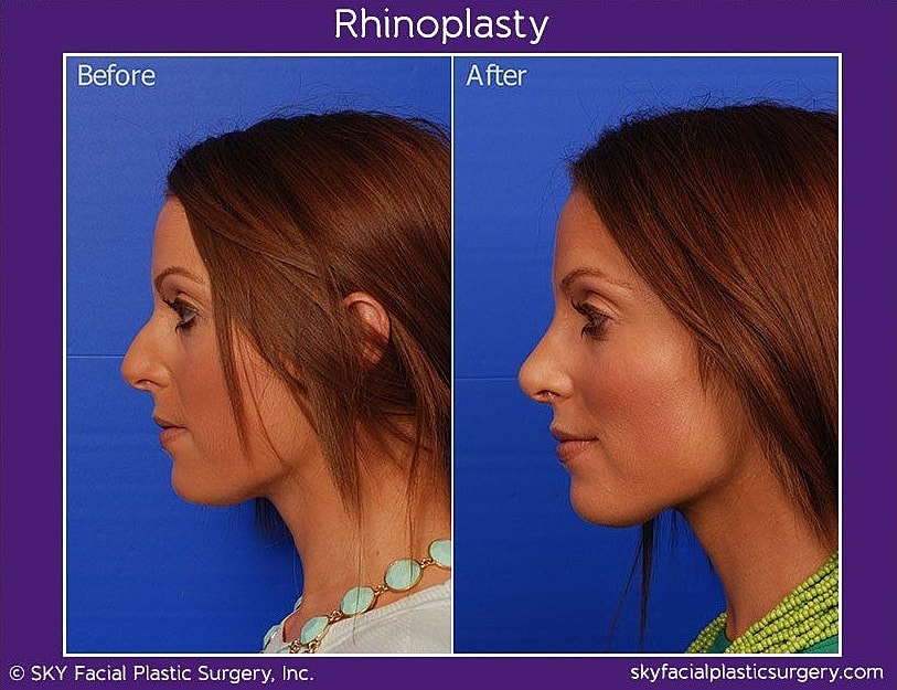 Rhinoplasty Before & After