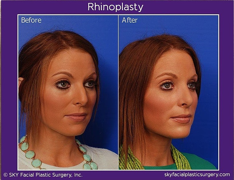 Rhinoplasty Before & After