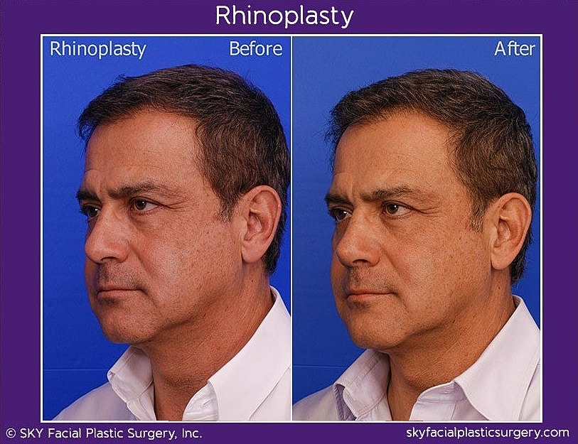 Rhinoplasty Before & After