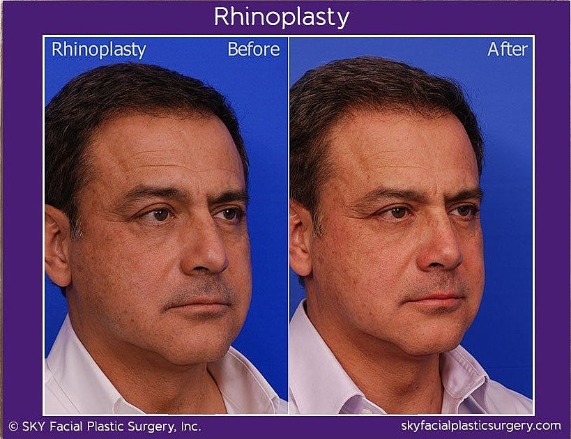 Rhinoplasty Before & After