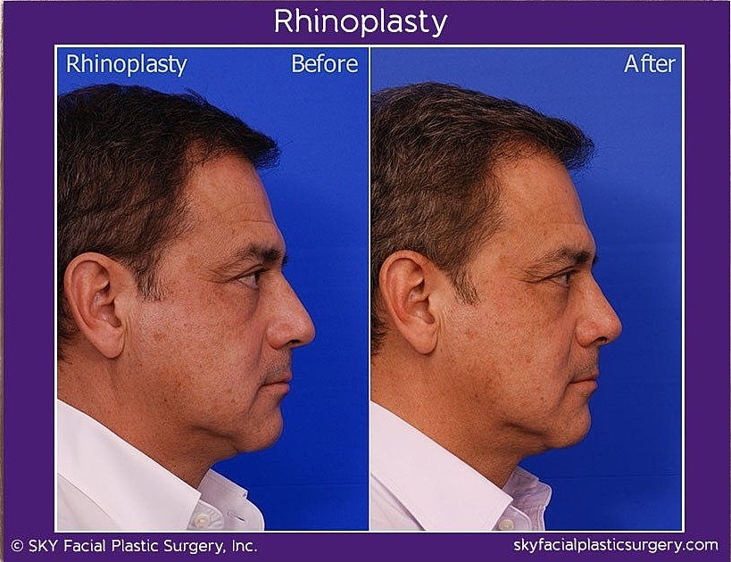 Rhinoplasty Before & After