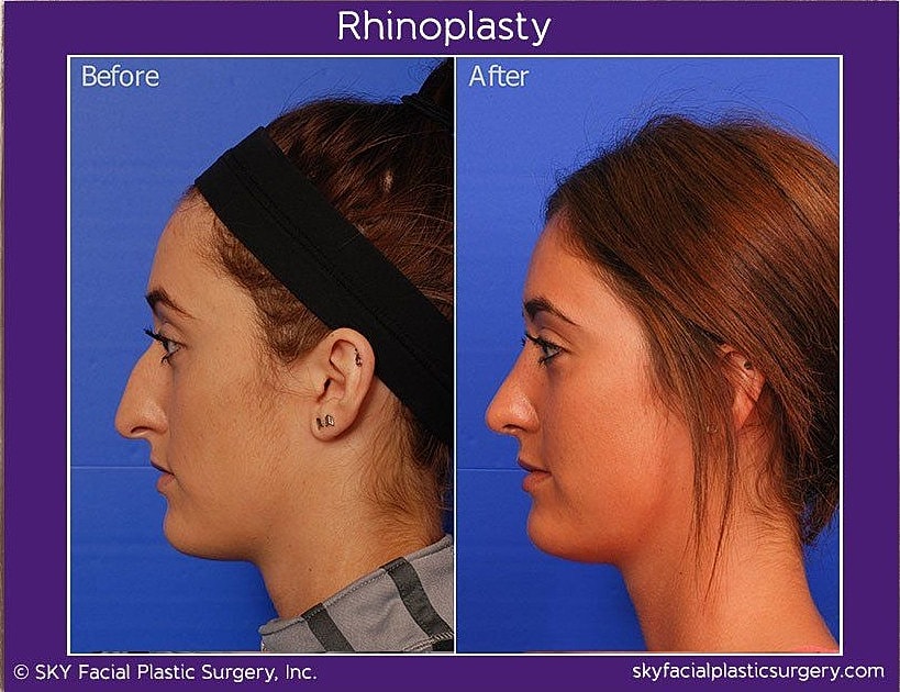 Rhinoplasty Before & After