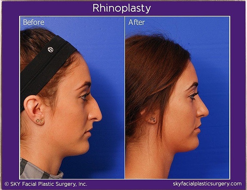 Rhinoplasty Before & After