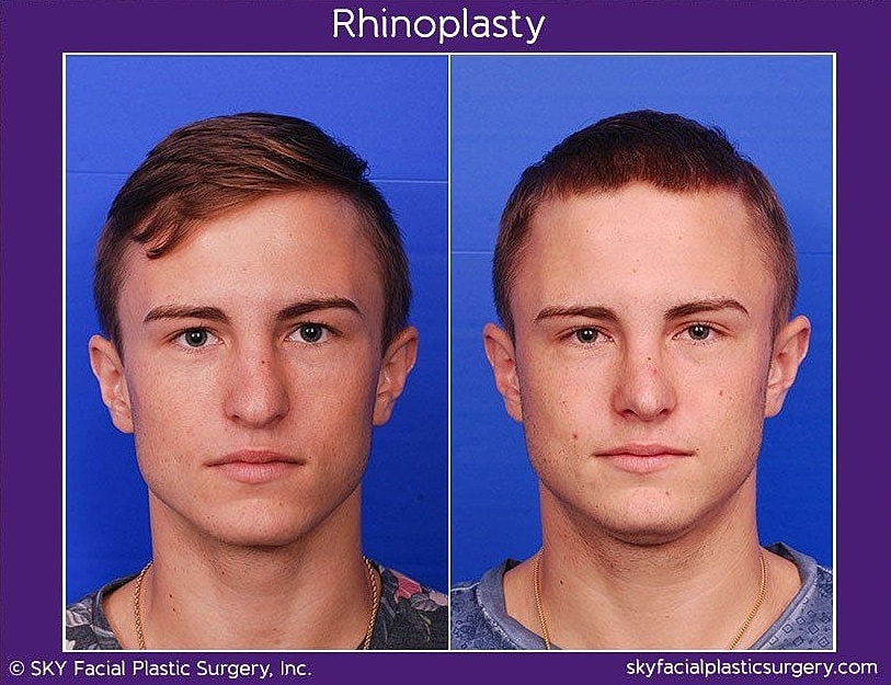 Rhinoplasty Before & After