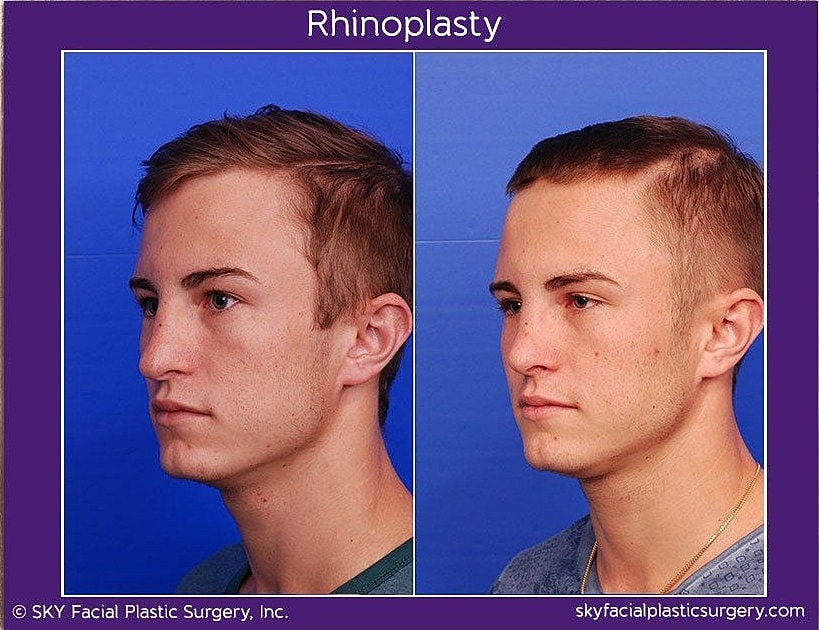 Rhinoplasty Before & After