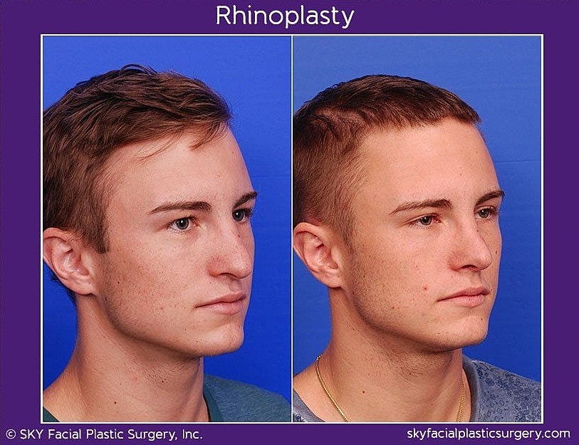 Rhinoplasty Before & After