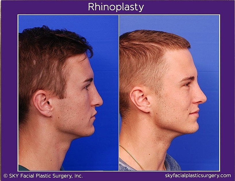Rhinoplasty Before & After