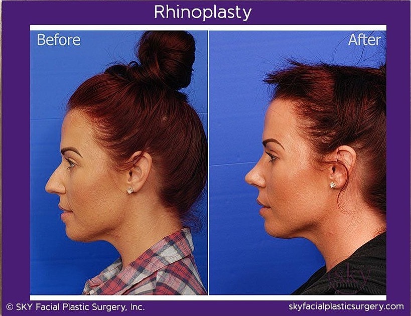 Rhinoplasty Before & After