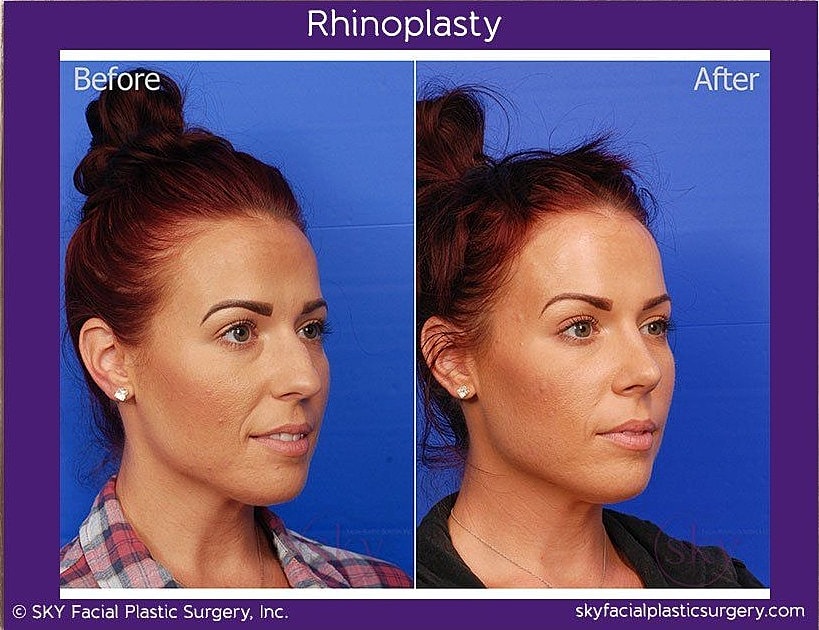 Rhinoplasty Before & After