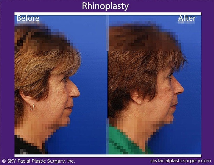 Rhinoplasty Before & After
