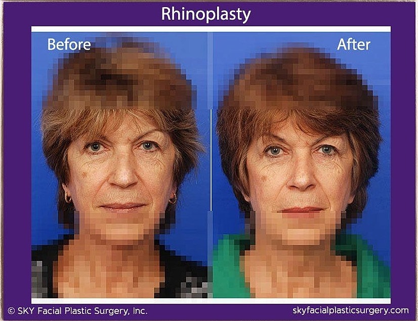 Rhinoplasty Before & After