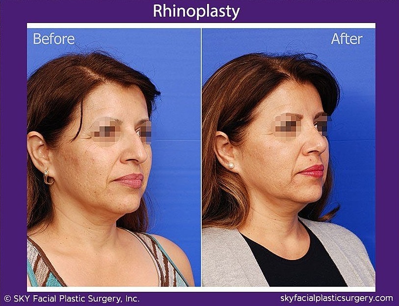 Rhinoplasty Before & After
