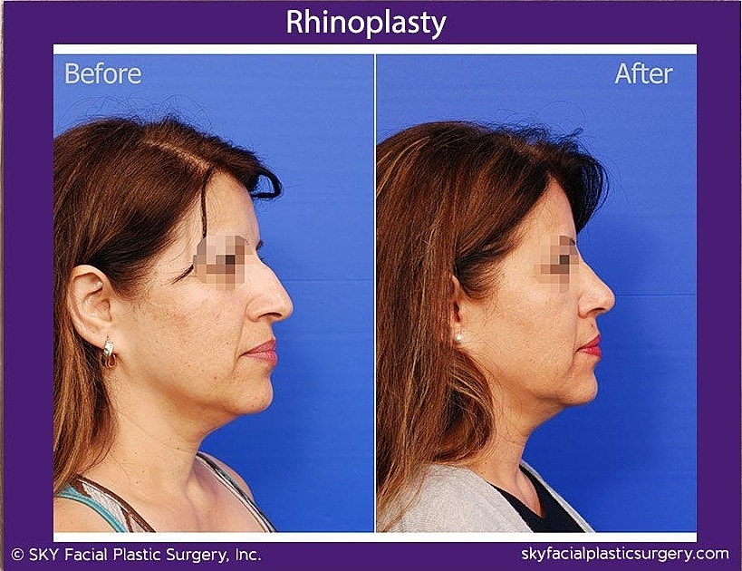 Rhinoplasty Before & After
